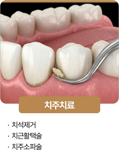 365서울진심치과 치주치료